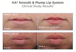 A picture of the lip line and how it looks after using the lip plump system.