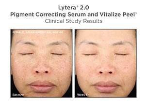 A woman with brown eyes and dark hair is shown before and after using lytera.