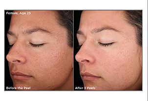 A woman with a large pores on her face and the skin is still smooth.